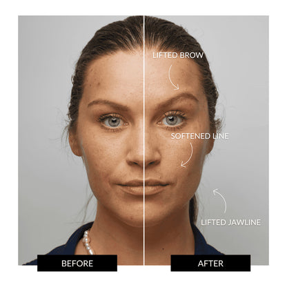 HALO Facial Toning Device